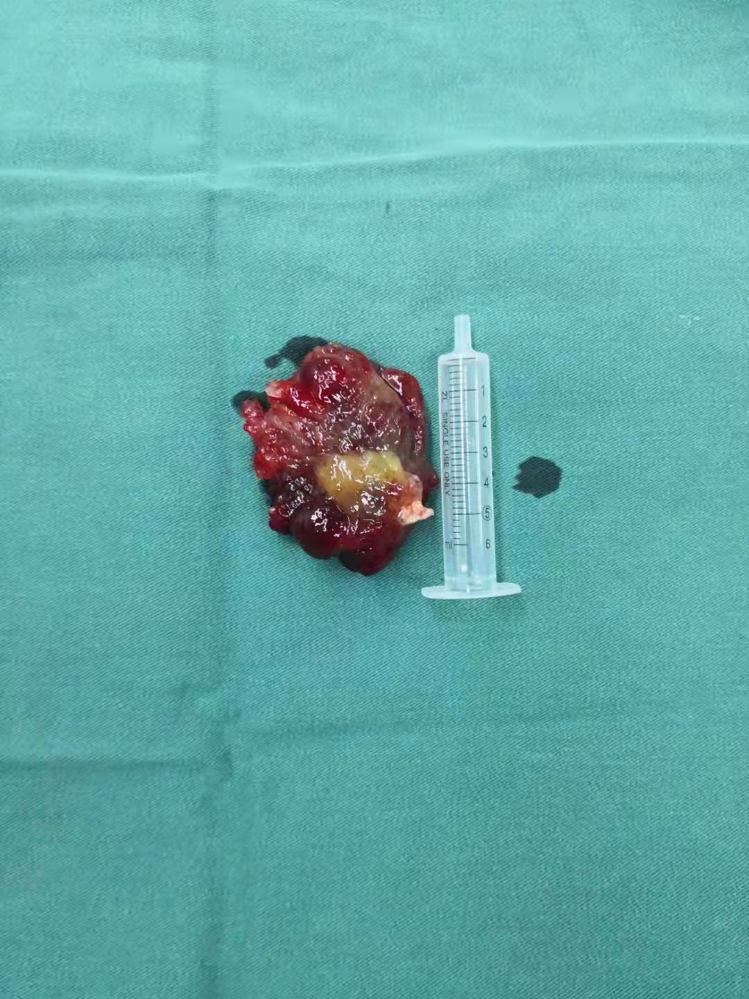 手术2.jpg 手术2.jpg