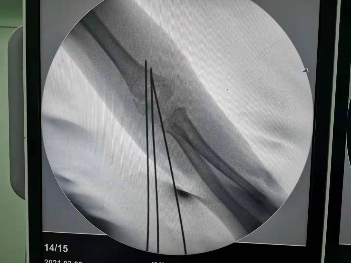 微创治疗儿童肱骨髁上骨折2.png 微创治疗儿童肱骨髁上骨折2.png