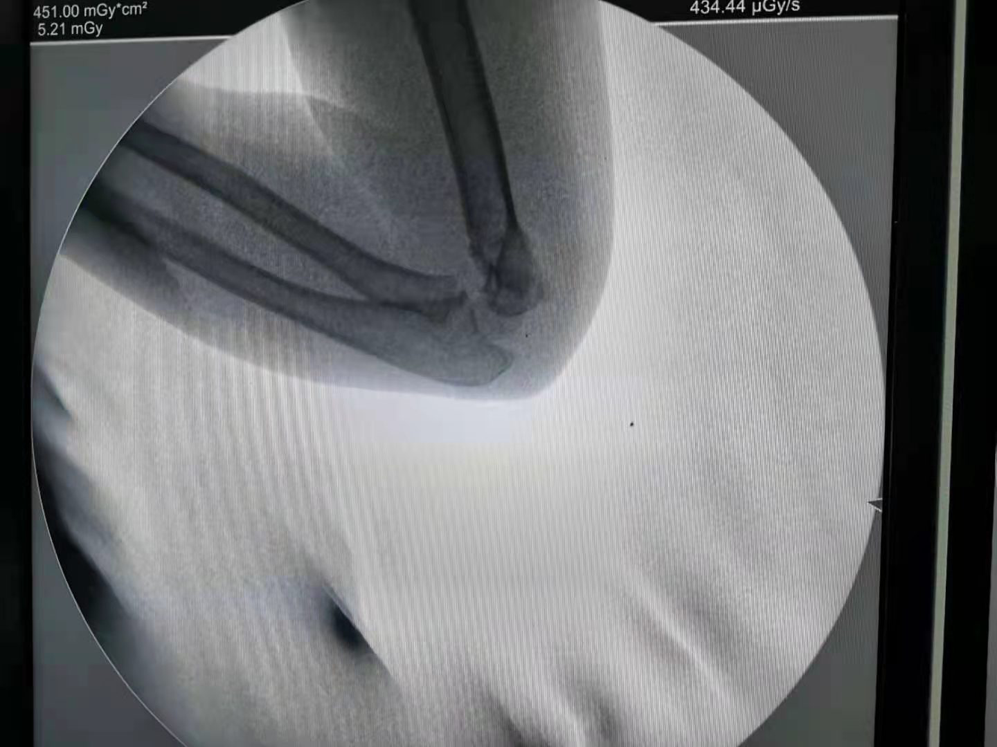 微创治疗儿童肱骨髁上骨折1.png 微创治疗儿童肱骨髁上骨折1.png