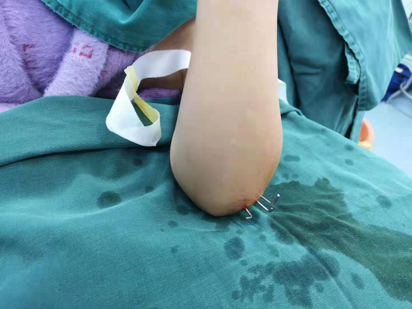 微创治疗儿童肱骨髁上骨折4.png 微创治疗儿童肱骨髁上骨折4.png