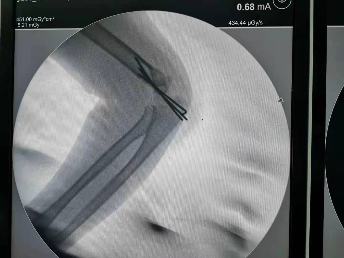 微创治疗儿童肱骨髁上骨折3.png 微创治疗儿童肱骨髁上骨折3.png