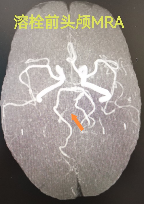 溶栓前右侧椎动脉闭塞.jpg 溶栓前右侧椎动脉闭塞.jpg