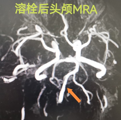溶栓后闭塞的右侧椎动脉被完全开通.jpg 溶栓后闭塞的右侧椎动脉被完全开通.jpg